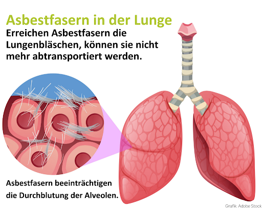 Abbildung einer Lunge mit einer Vergrößerung eines Bereichs, in dem Asbestfasern und Zellen im Gewebe erkennbar sind.